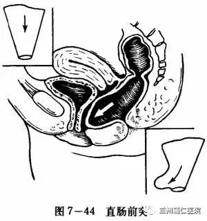 7.腹胀 直肠前突