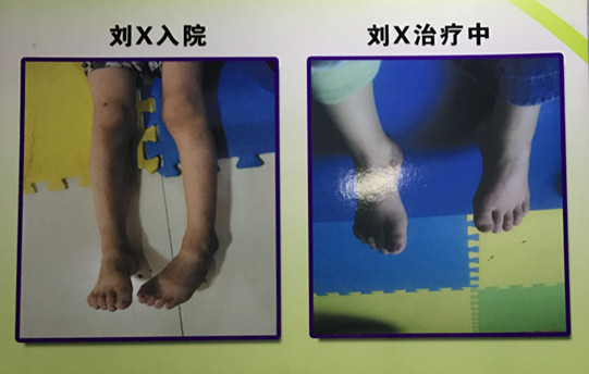 小天使康复中心典型康复病例