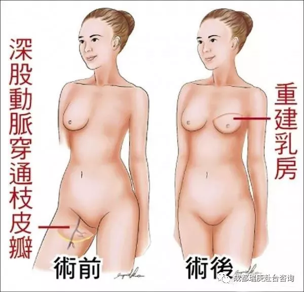 台湾长庚医院乳房重建中心主任黄嫆茹提供