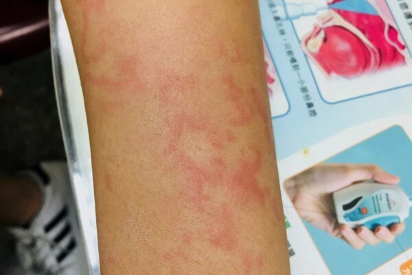 急性荨麻疹、慢性荨麻疹