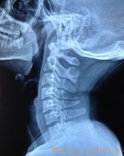 为什么颈椎病患者易出现项韧带钙化?