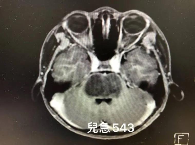 台湾长庚医院治脑瘤