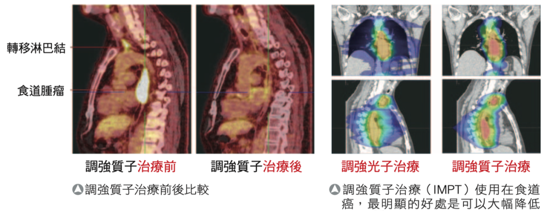 台湾长庚医院质子治疗食道癌