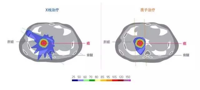 大陆青年赴台质子治疗肝癌