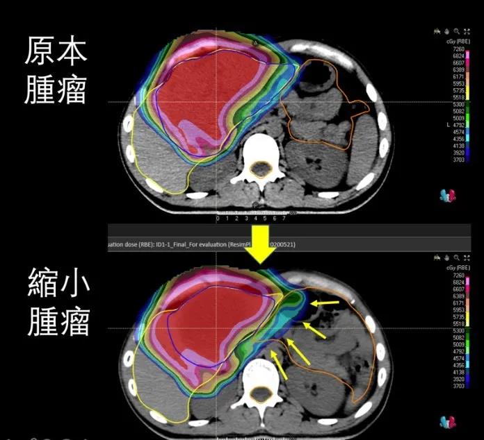 台湾高雄长庚医院接受质子治疗