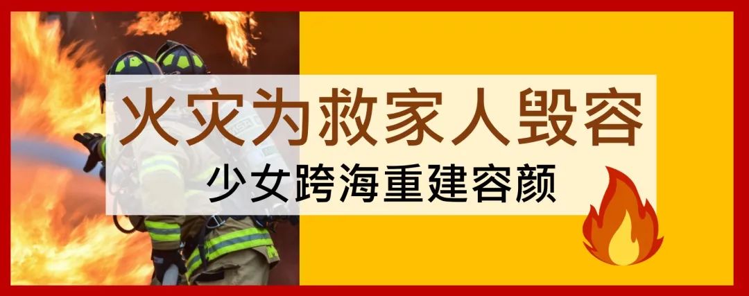 【台湾长庚医院】火灾为救家人毁容 少女跨海来台重建容颜 【台湾长庚医院】火灾为救家人毁容 少女跨海来台重建容颜