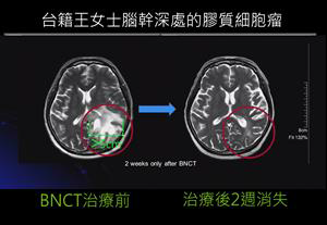 台湾硼中子捕获治癌 | 西班牙脑瘤病患跨海求治