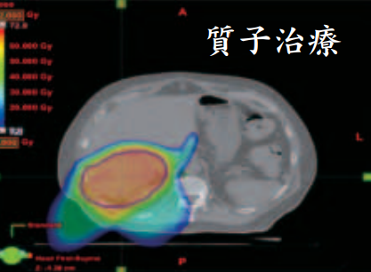 质子治疗杀肿瘤提高局部控制率