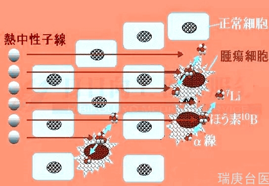 硼中子俘获疗法的独特作用