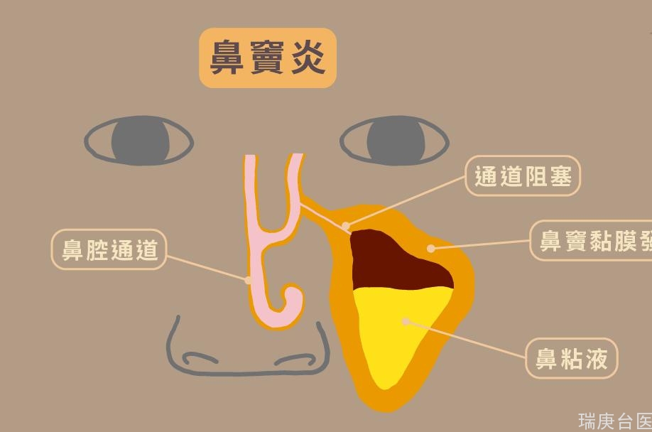 臺灣長庚醫院案例 | 鼻塞、流鼻水及頭痛，居然是鼻竇炎