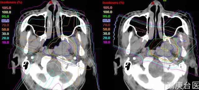复发鼻咽癌 | 质子治疗有明显优势