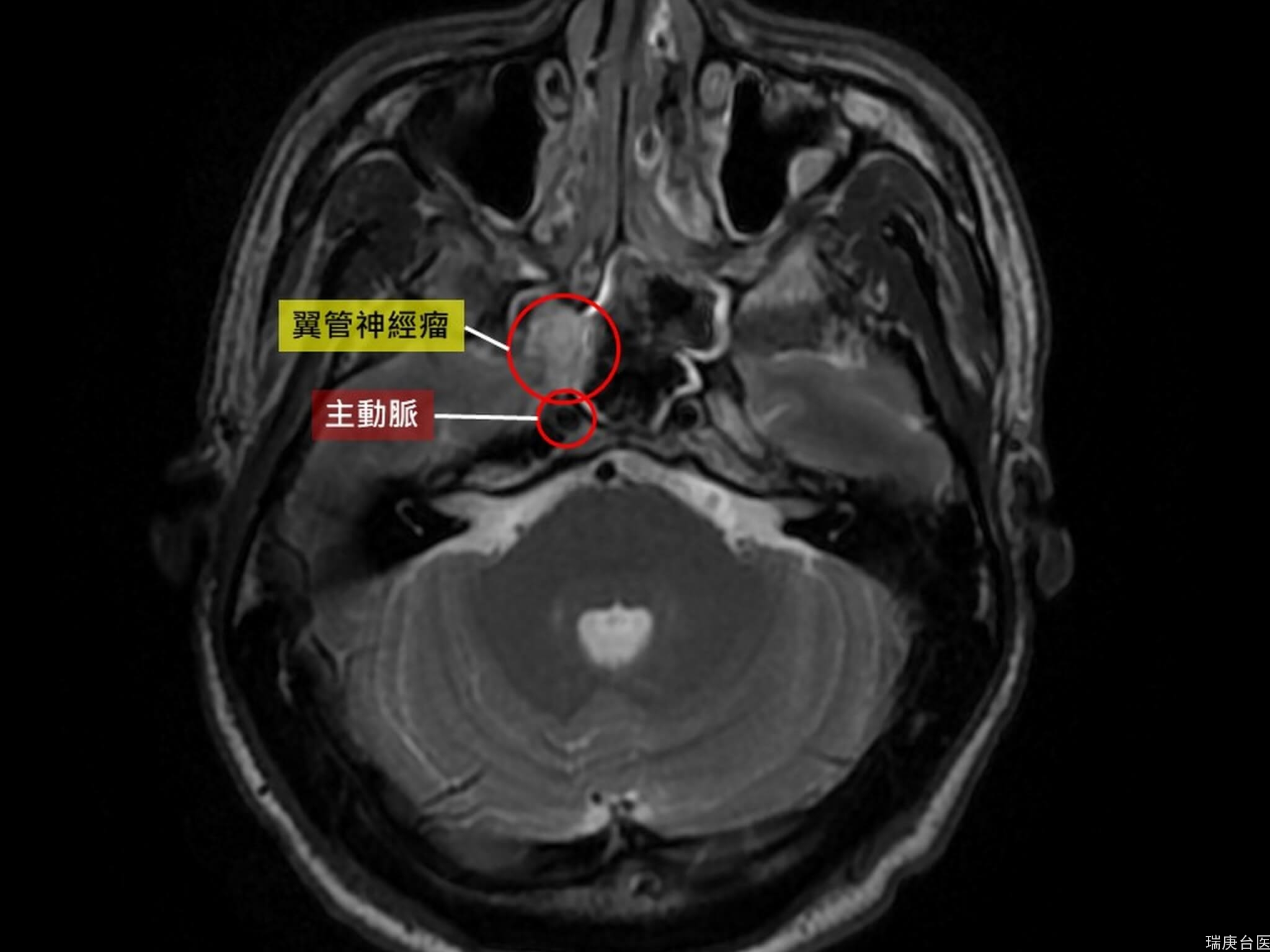 台湾首例！鼻水狂流原来是全球不到20例的罕见神经瘤