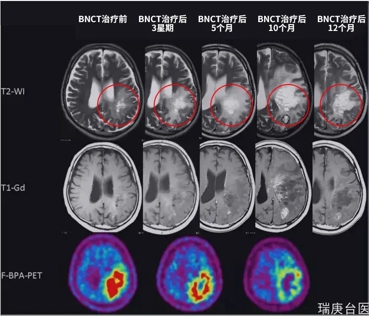BNCT案例 | 如何一步步杀灭脑胶质瘤细胞？