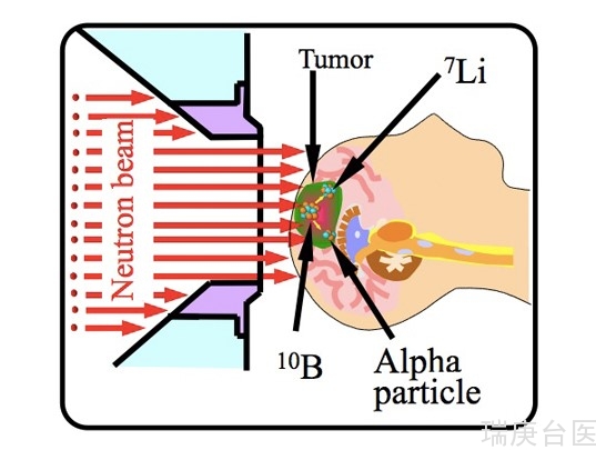 BNCT案例 | 胶质瘤术后复发硼中子捕获治疗
