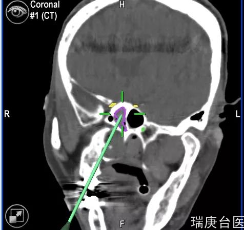 【台湾长庚医院】iCT导航鼻窦炎内视镜手术