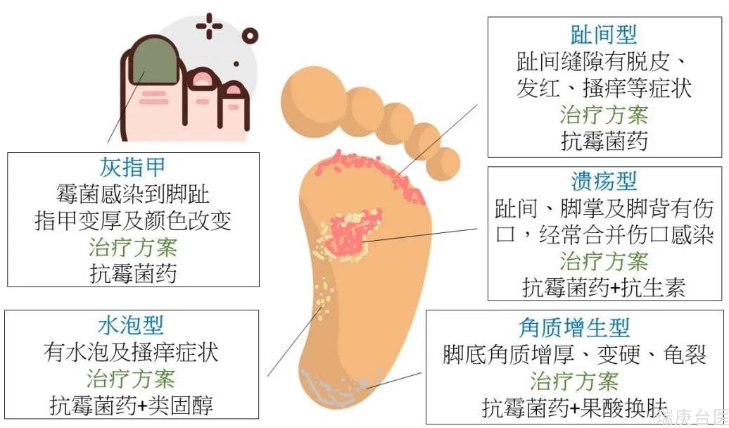 【台湾长庚医院】我得了灰指甲、香港脚了吗？