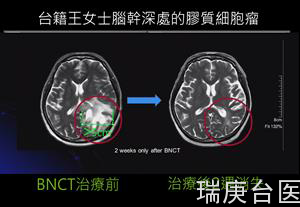 BNCT案例 | 台湾硼中子捕获治疗标靶辐射治癌