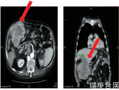【台湾长庚医院】80岁以上肝癌患者仍可经由肝脏切除手术治疗