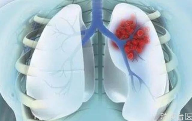 質子治療肺癌 | 年長、肺功能不良者可考慮
