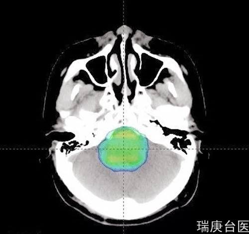 案例分享 | 质子治疗脑干胶质瘤的效果