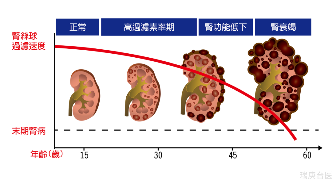 【台湾长庚医院】多囊肾到底是先天还是后天性疾病？能够治愈吗？