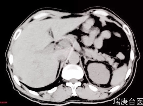 案例分享 | 食管癌腹膜后淋巴结转移 ,质子治疗肿瘤完全消失