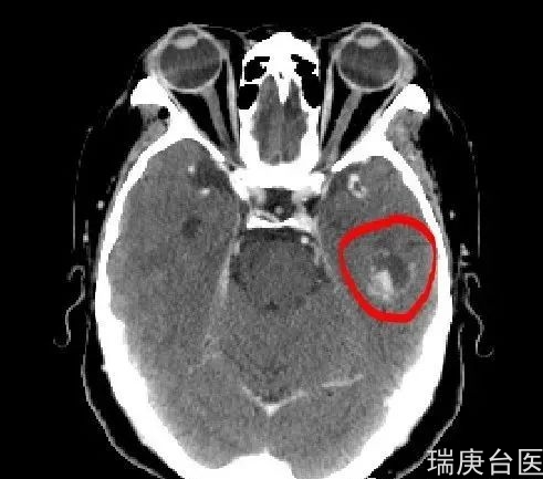 质子治疗 | 长在眼睛、脑子、脊柱等重要器官，无法手术容易复发肿瘤的新选择