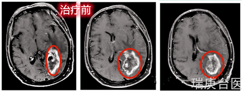 质子治疗案例 | 肺癌术后脑转移瘤质子治疗后肿瘤明显缩小